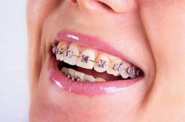 Các ưu và nhược điểm khi sử dụng phương pháp niềng răng kim loại