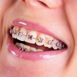Những điều cần biết về phương pháp niềng răng mắc cài kim loại