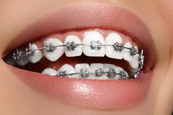 Thời gian niềng răng mắc cài kim loại là bao lâu?