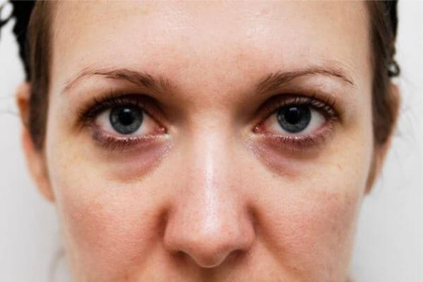 Quầng thâm mắt có thể do nhiều nguyên nhân gây ra